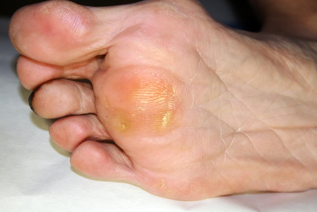 hard painful corn on bottom of foot