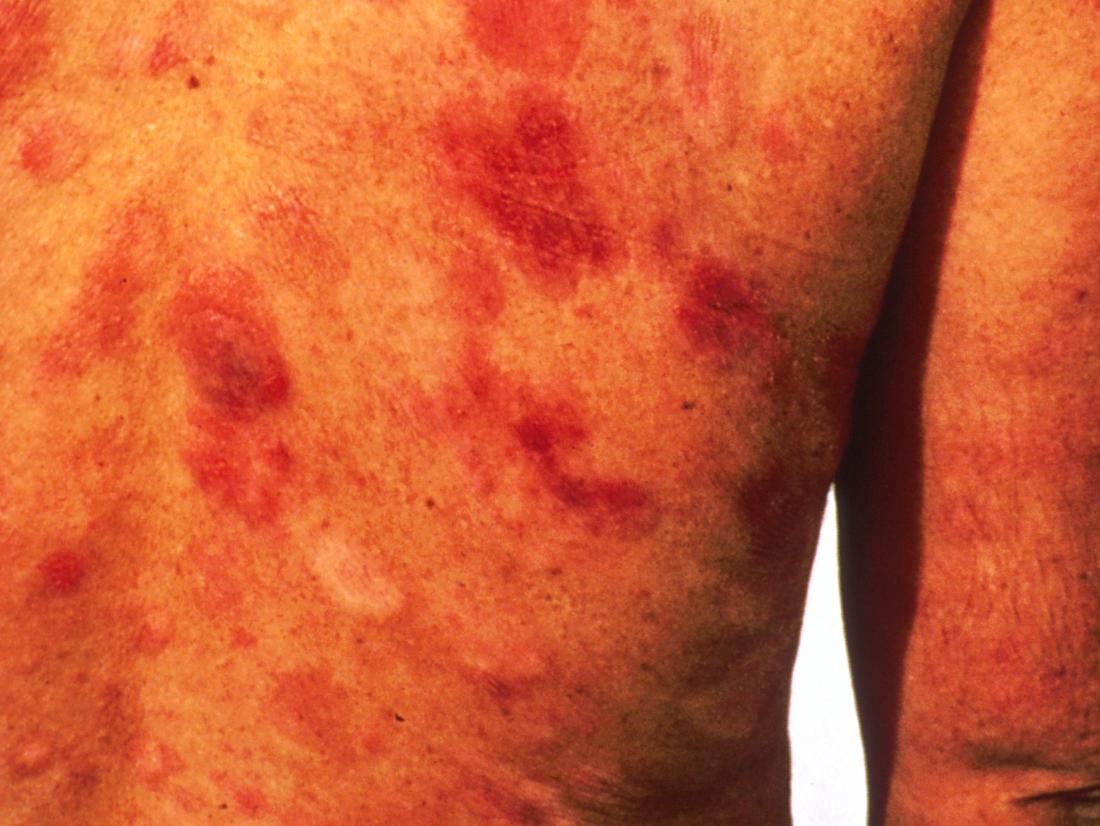 Kaposi Sarcoma Causes Symptoms And Treatment