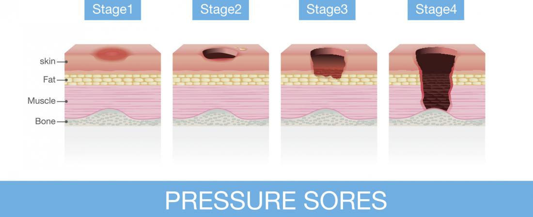 Pressure sores prone areas affected by body position on bed. (a).