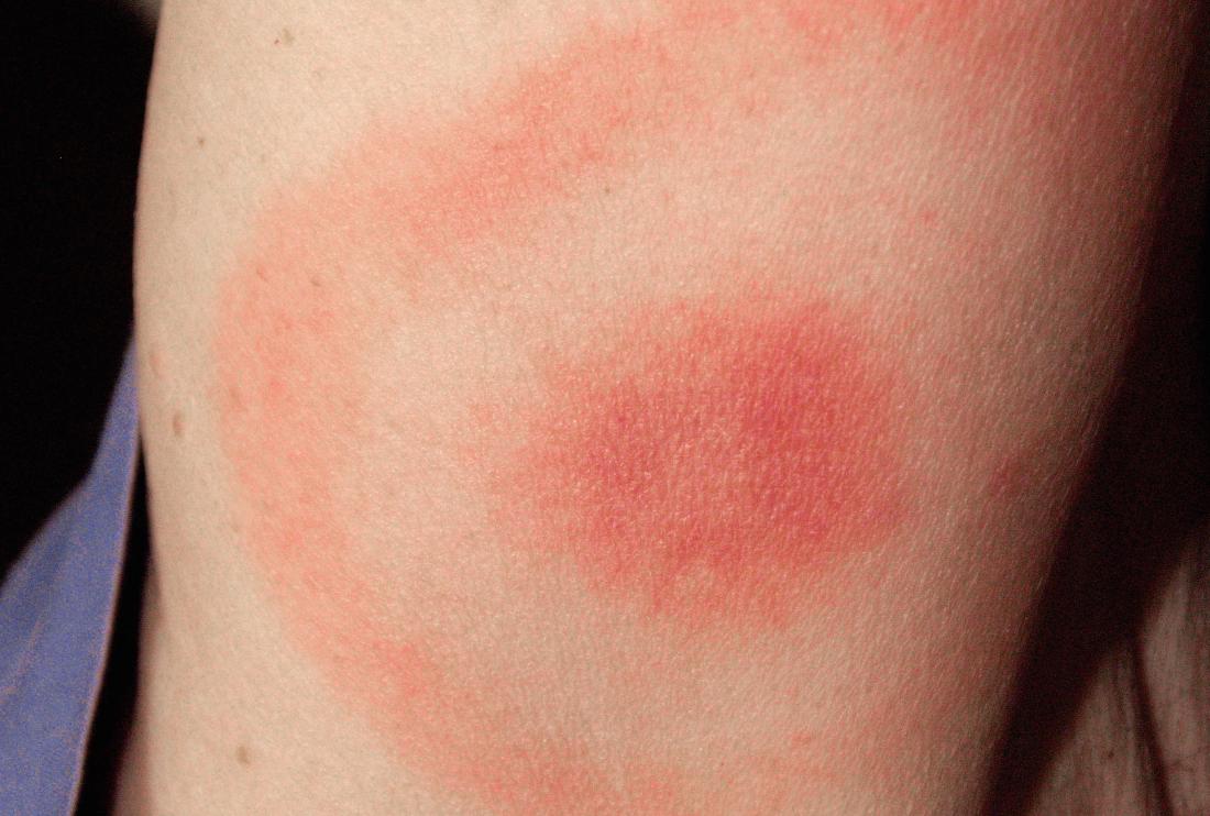 Insect Bites Reactions Types And Images