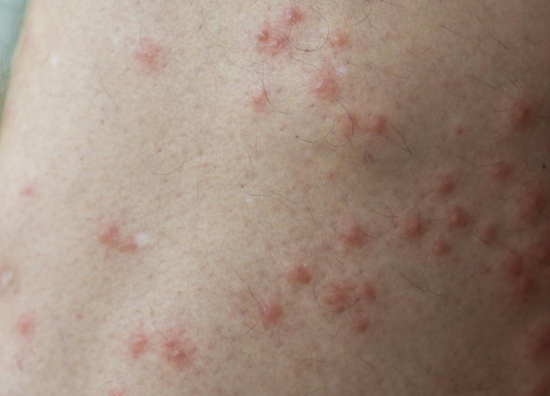 What does an allergic reaction to spider bites look like