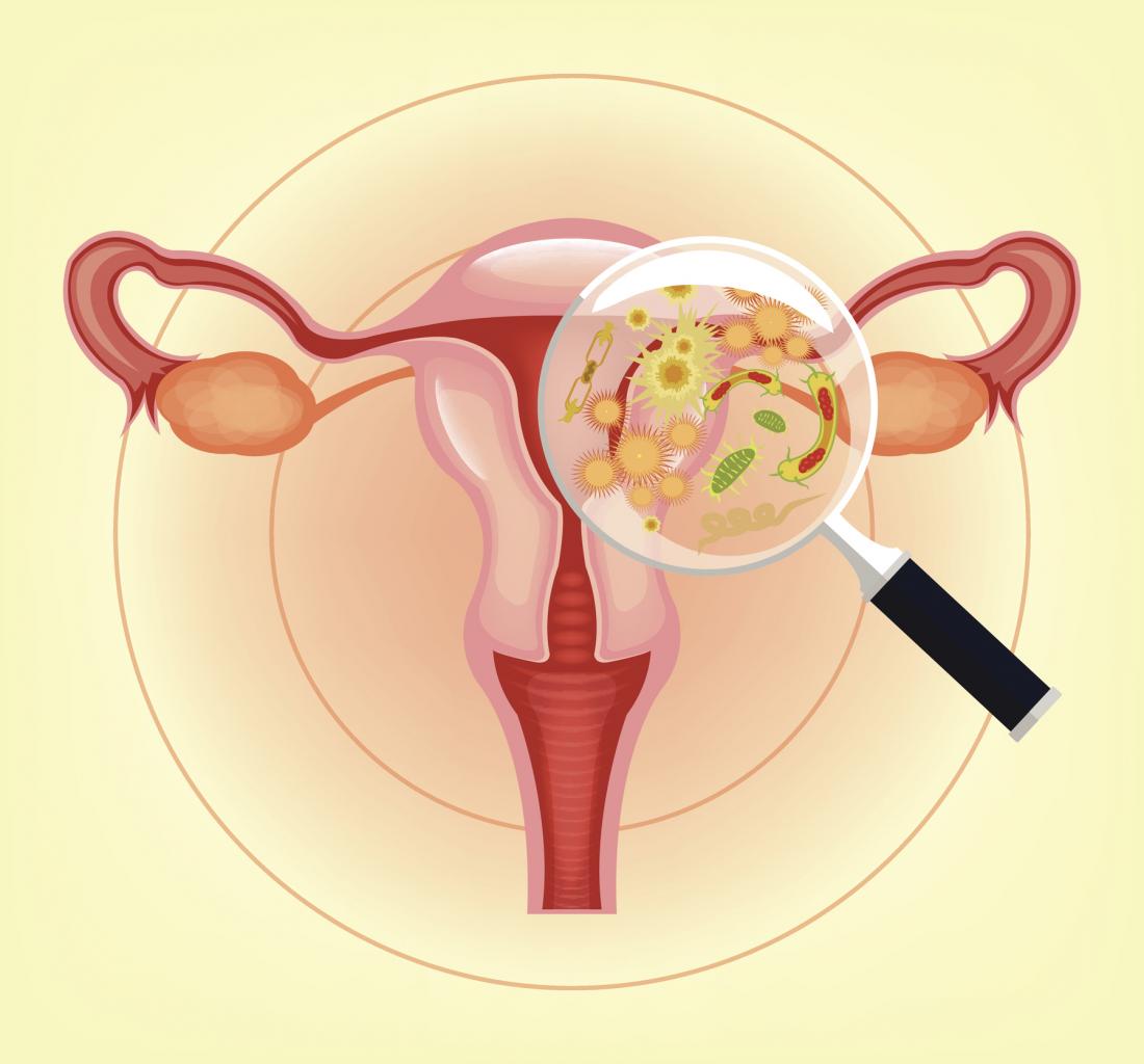 Vaginitis: Types, symptoms, causes, and treatment