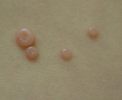 szemölcsök és molluscum contagiosum