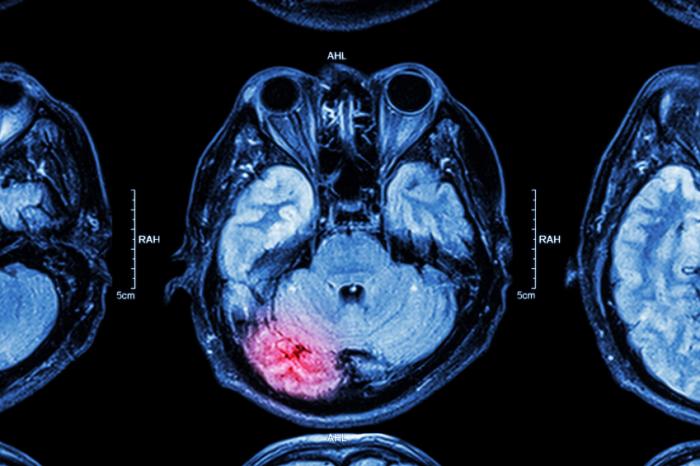 Finally, A Blood Test for Traumatic Brain Injury