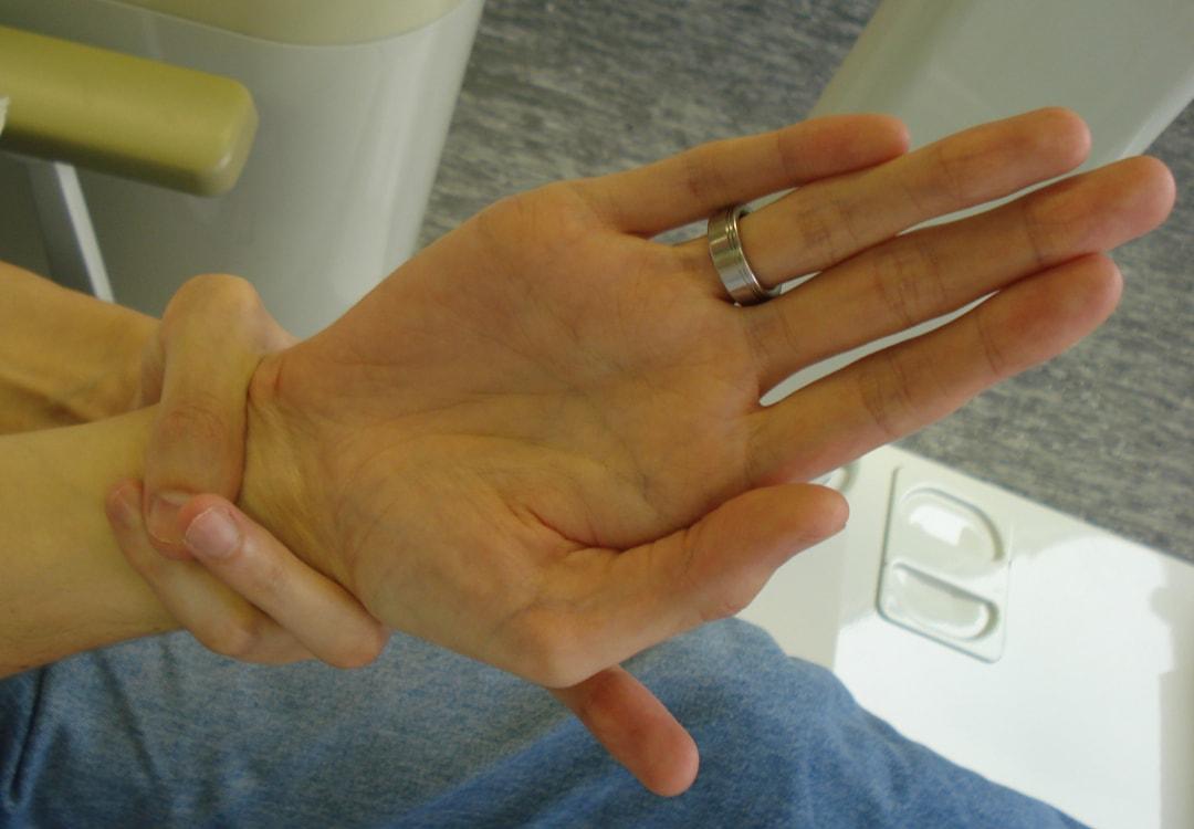 marfan syndrome hands