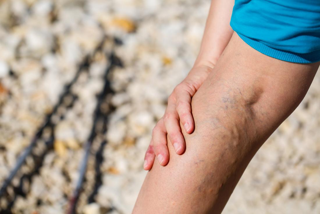 people with varicose veins are more likely to develop varicose eczema