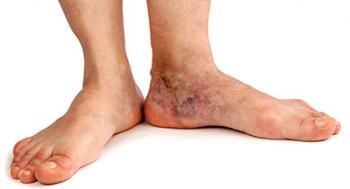 Varicose Eczema Or Stasis Dermatitis Symptoms Causes And Treatment