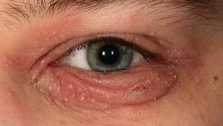 Blepharitis Treatment Symptoms Pictures And Causes