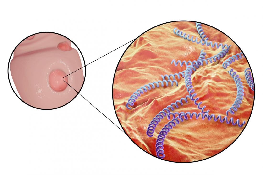 Syphilis Causes Risk Factors Symptoms And Treatment 8622