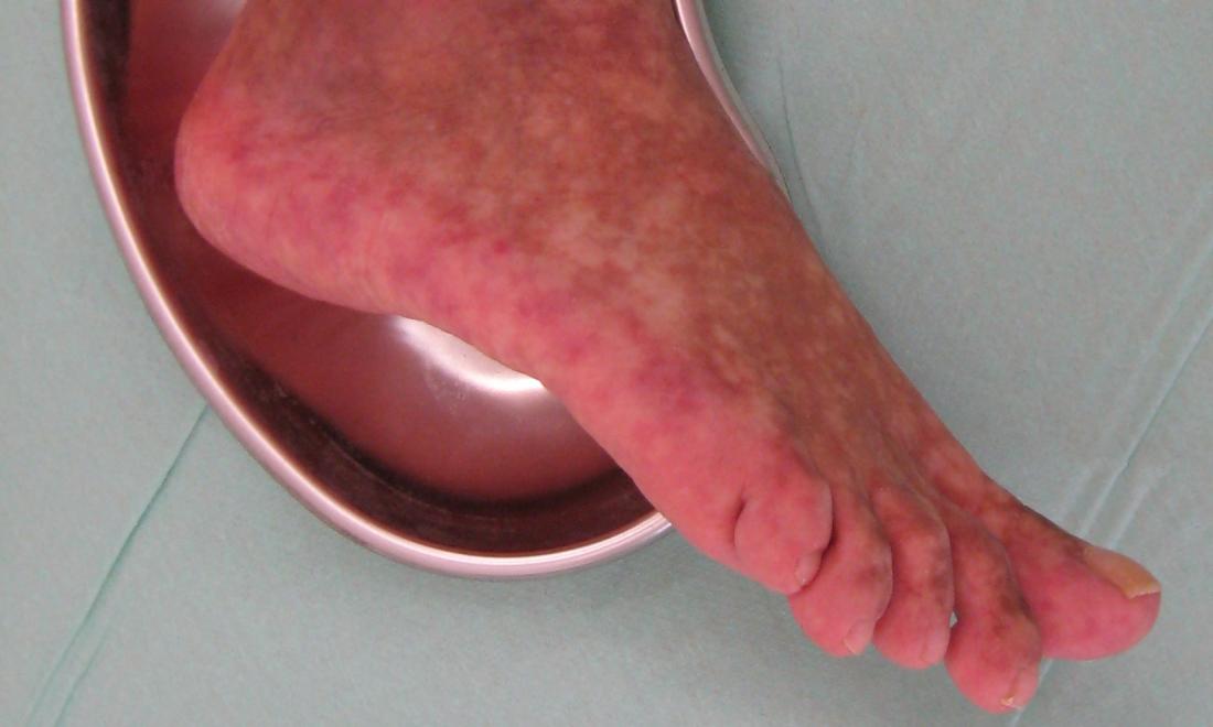 Red Spots On Foot