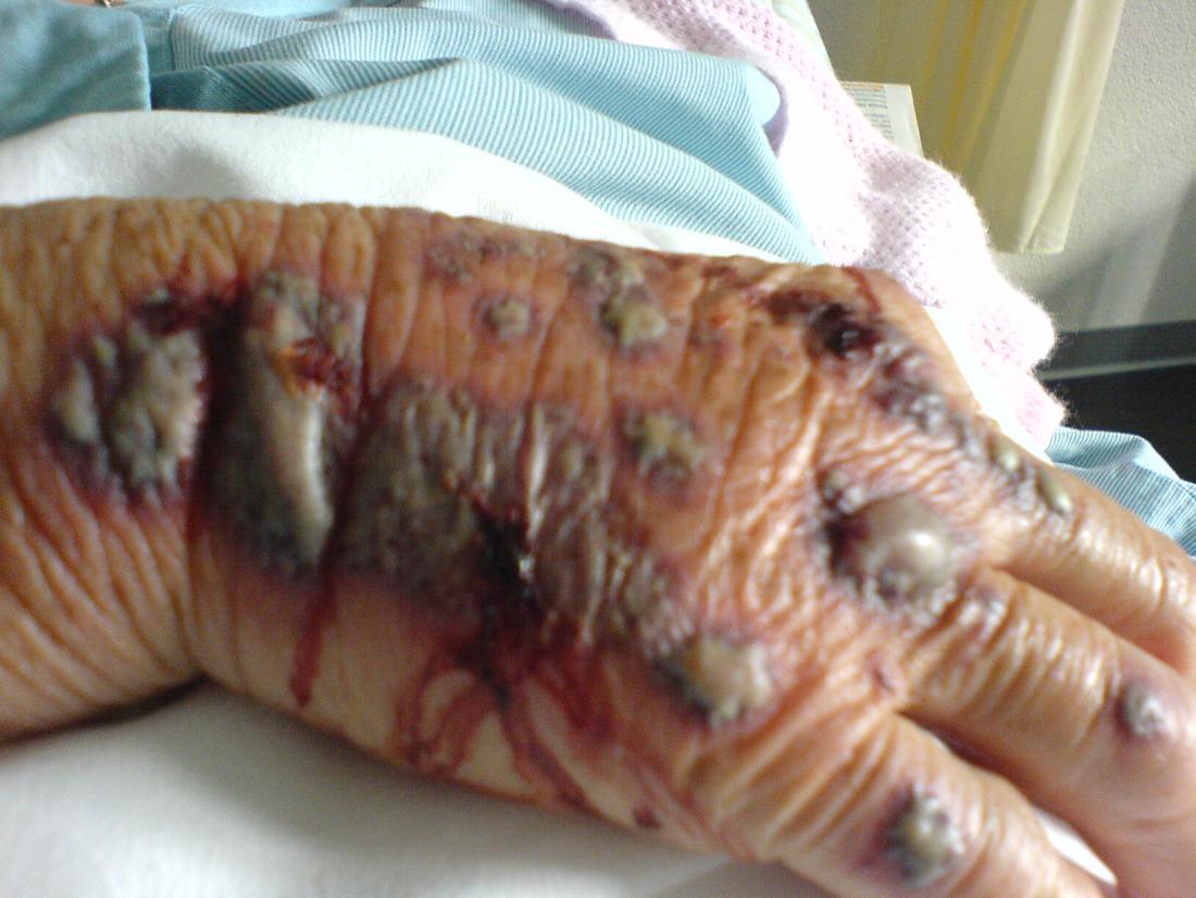 Vasculitis hand credit PDFrei, 2011