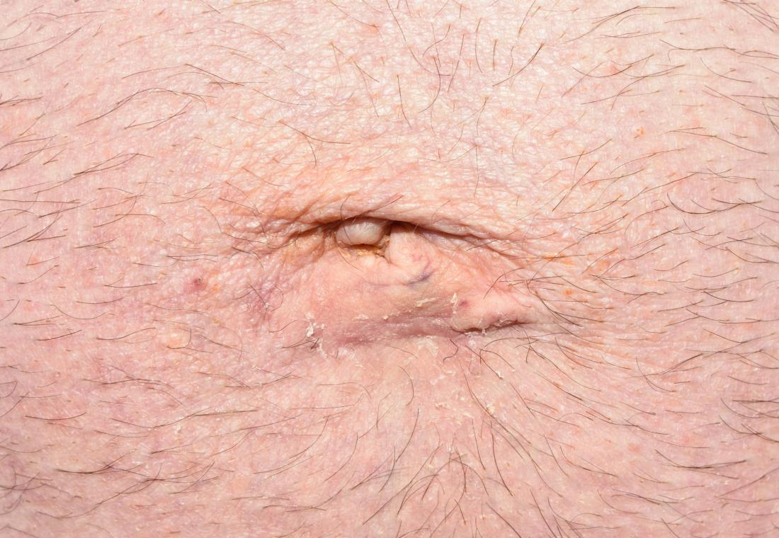 Umbilical hernia surgery