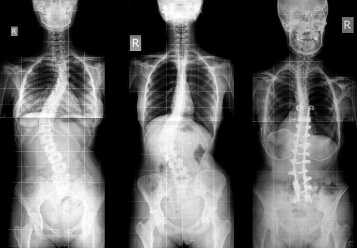 Image result for Scoliosis - What Happens In This Condition?
