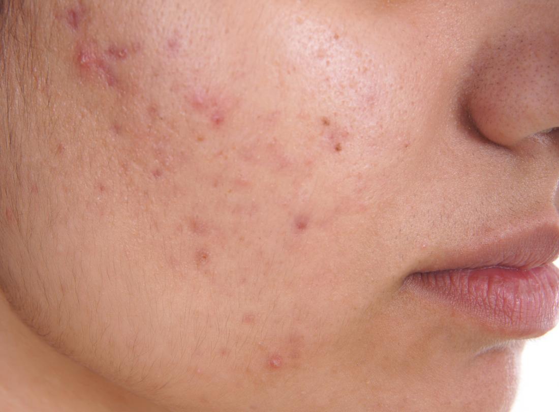 Acne: How to treat it