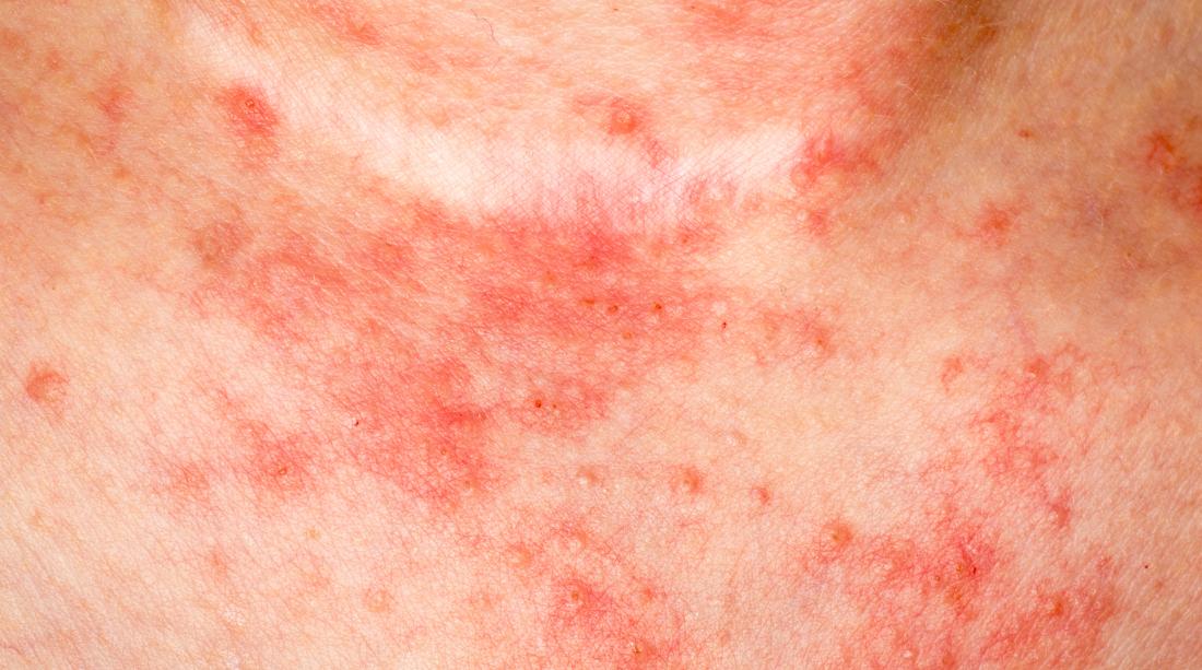 eczema resize