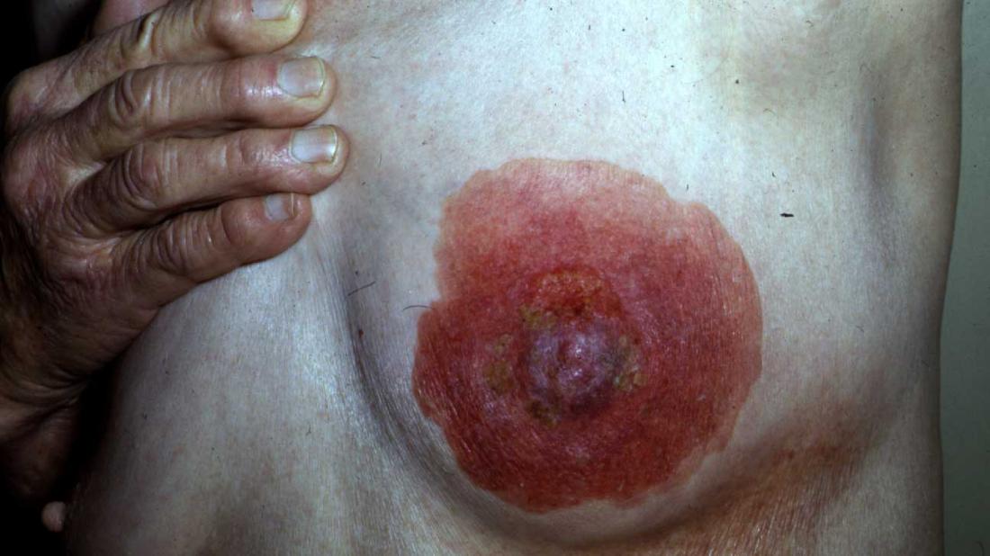 pagets disease