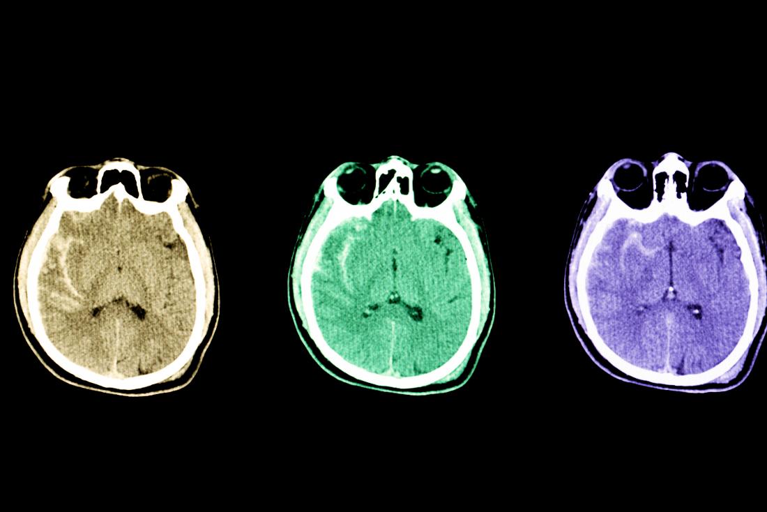 intraparenchymal hemorrhage vs subarachnoid hemorrhage