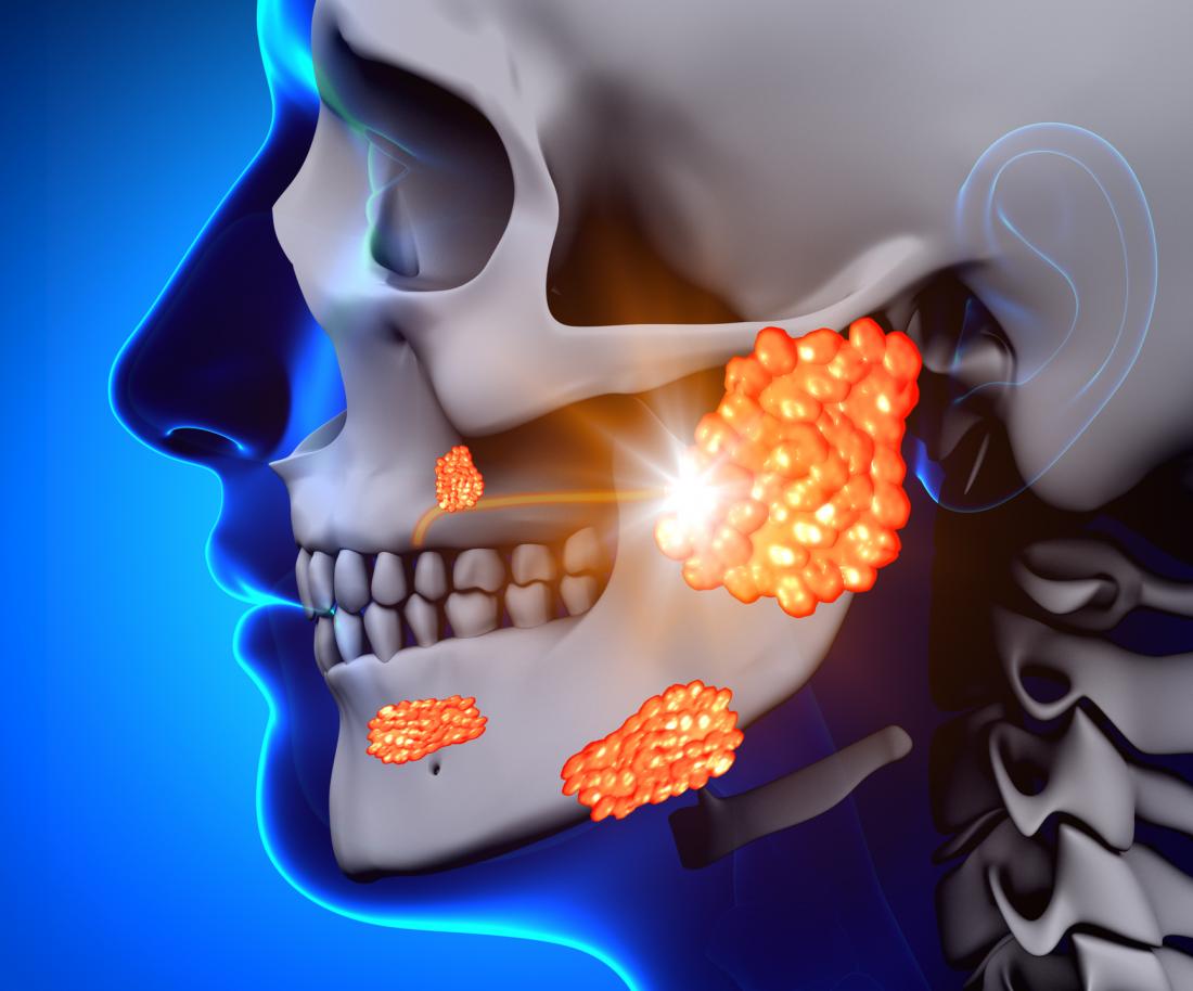 Mumps symptoms