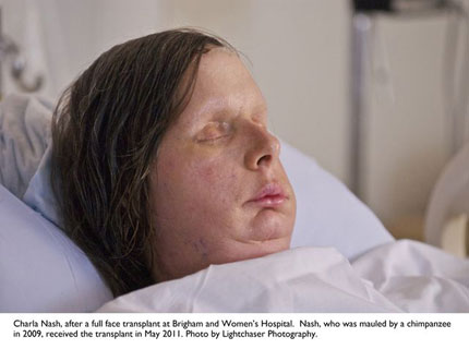 Charla Nash after her face transplant
