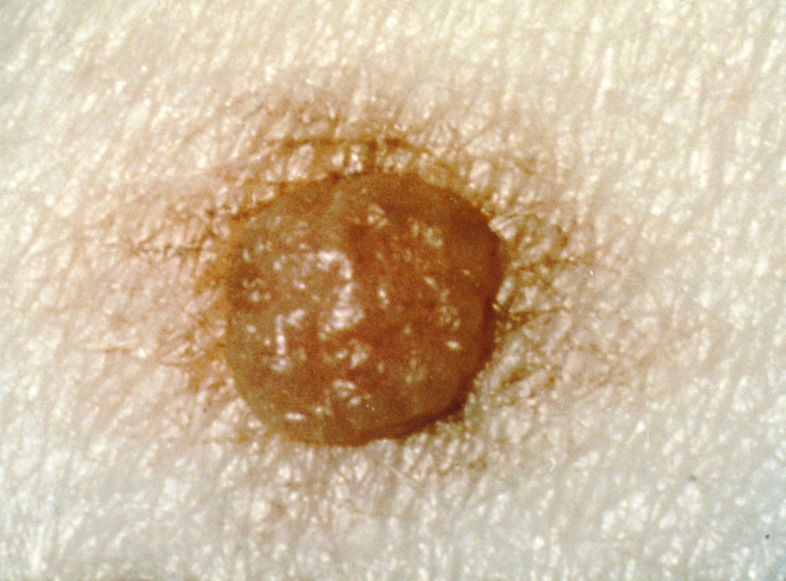 Moles Types Causes Treatment And Diagnosis