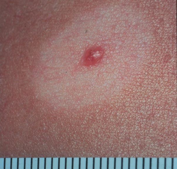Halo Nevus or Mole: Symptoms, Causes, Diagnosis, and Treatment