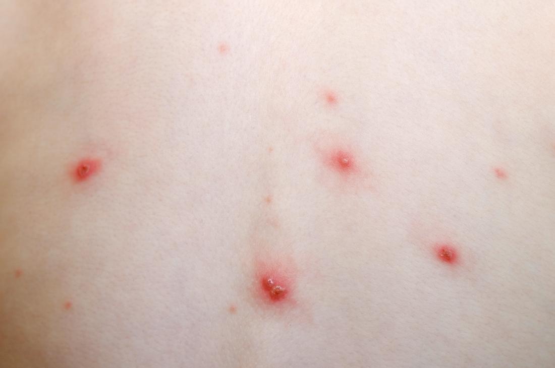 Chickenpox Symptoms, treatment, stages, and causes