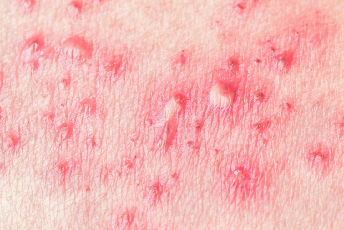 is the shingles virus contagious