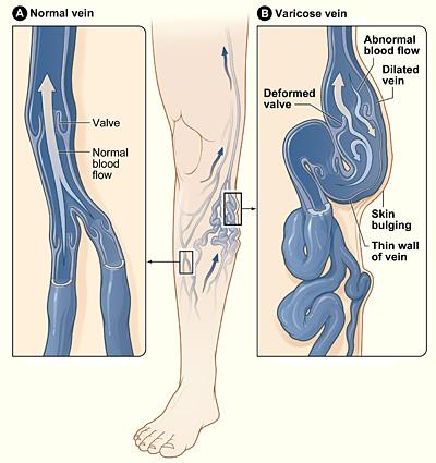 Diagram of varicose veins