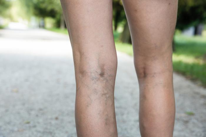 Varicose veins: Causes, treatment, diagnosis, and prevention