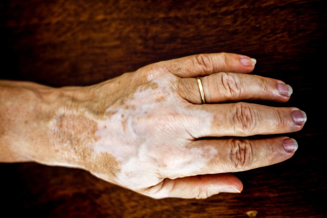 Vitiligo Symptoms, causes, and treatments