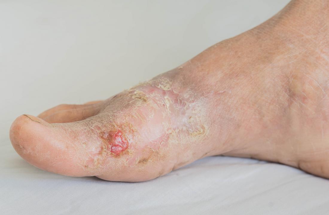 https://cdn-prod.medicalnewstoday.com/content/images/articles/245/245310/eczema-on-foot-with-diabetes.jpg