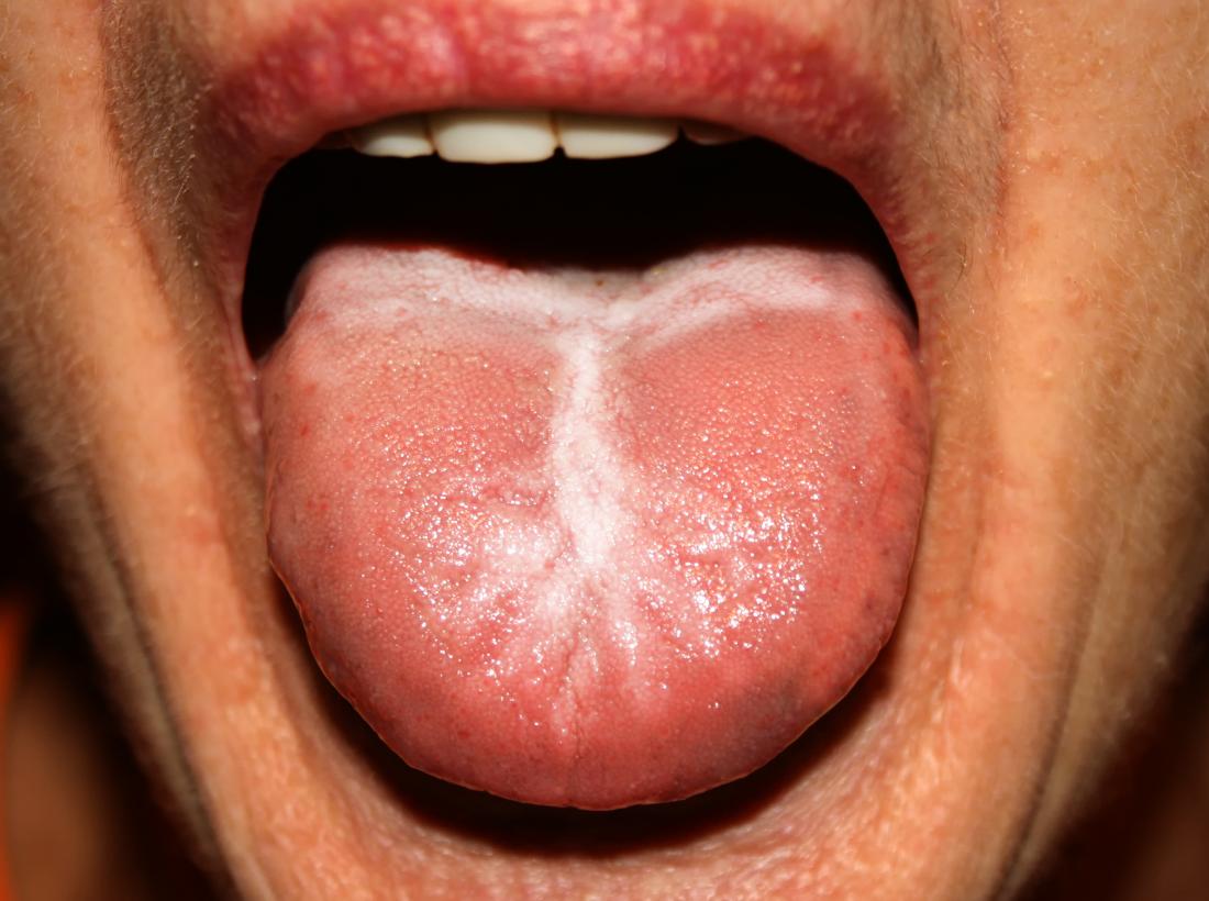 mild oral candidiasis