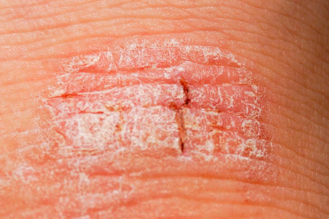 Plaque psoriasis