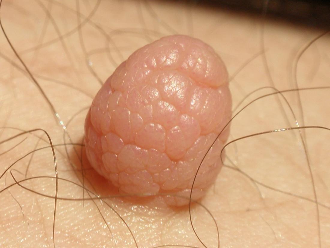 Fibroma tumor on the thigh. Photo credit: Dodoïste, 2012