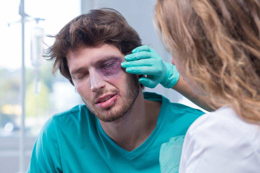 Black Eye: Causes and Treatment