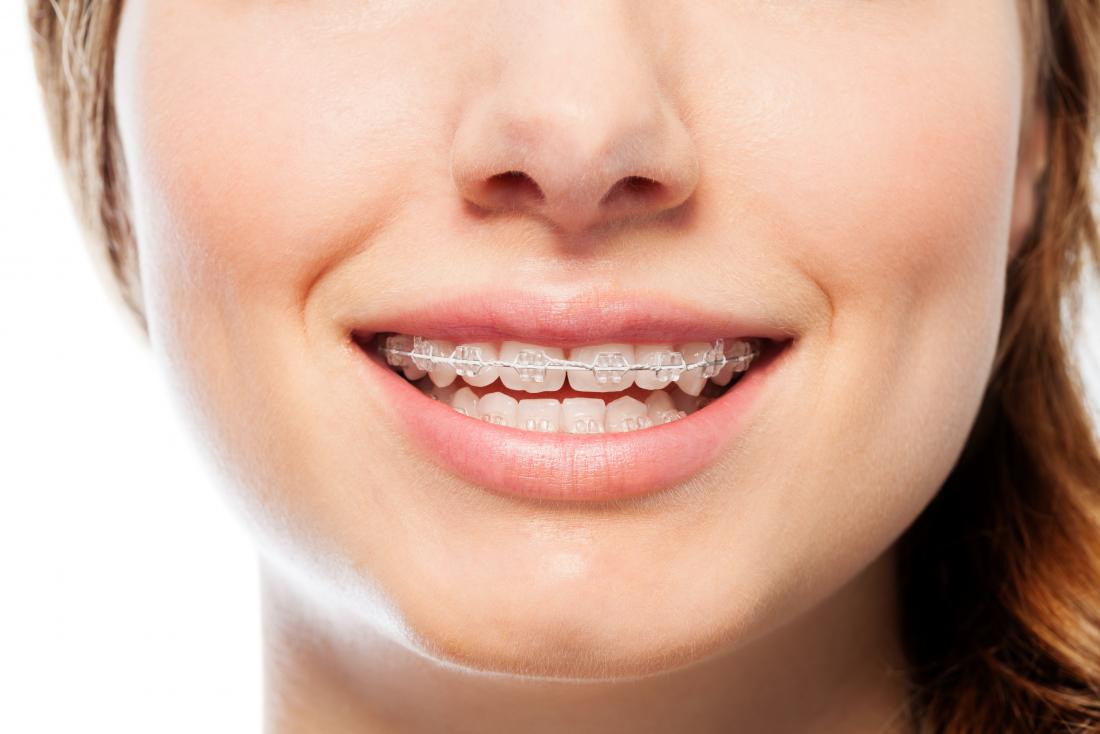 Get your front teeth straightened quickly without braces with