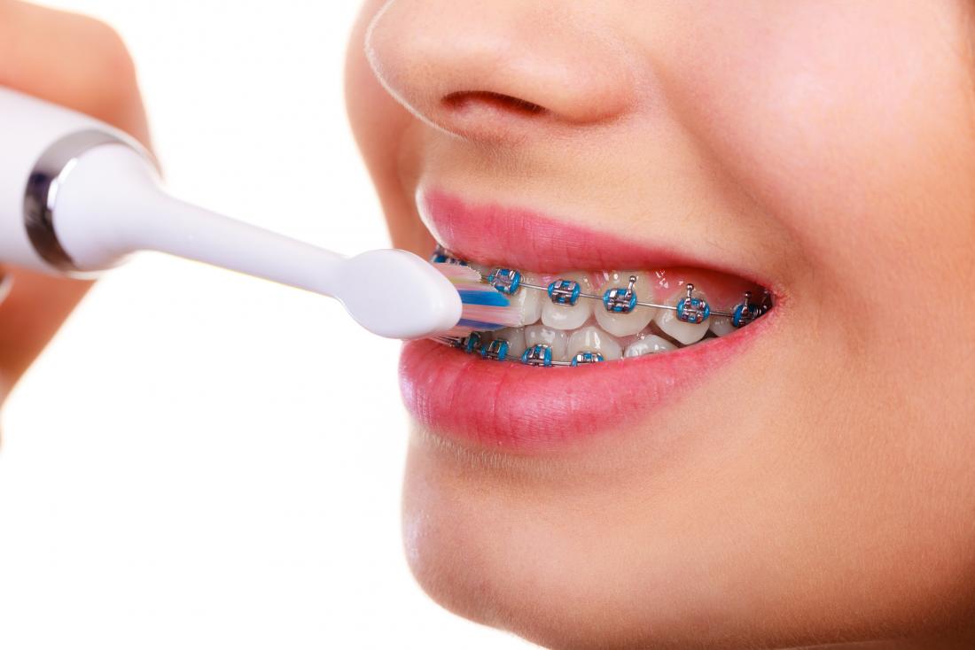 4 Dental Health Problems that can be Fixed by Orthodontic Treatment