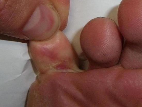 skin under toe keeps splitting