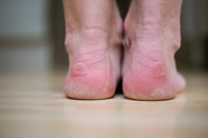 Blisters: Causes, treatments, and 