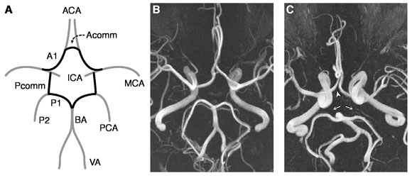 Migraine brain diagram - circle of Willis