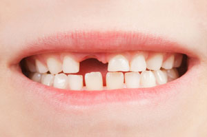 Mouth missing a tooth