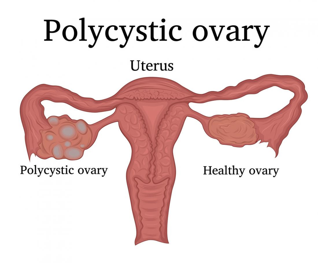 Polycystic Ovary Syndrome Pcos Causes Symptoms And Treatments 