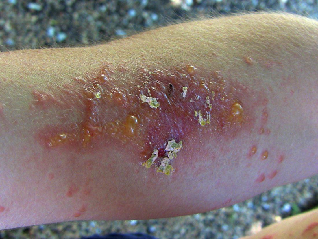 Poison ivy rash: Causes, treatment, and prevention