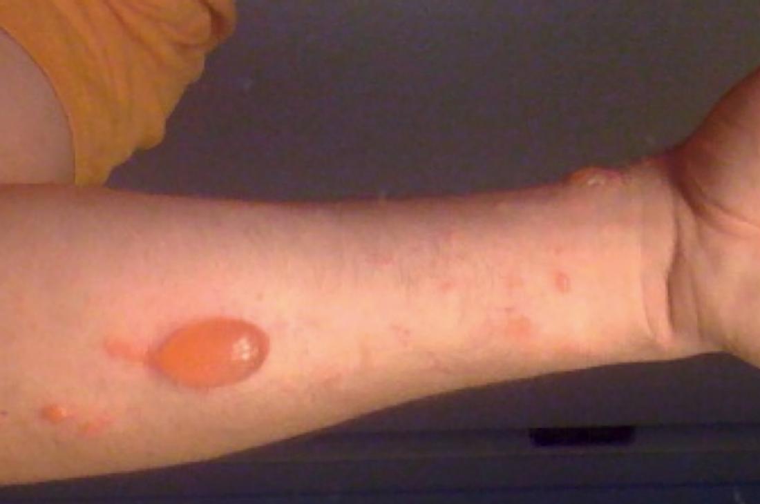 Poison ivy rash: Causes, treatment, and prevention