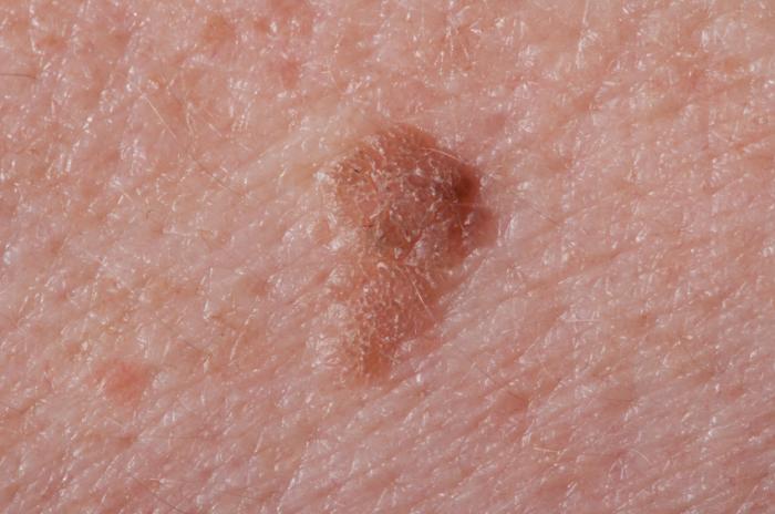 Seborrheic Keratosis Symptoms Treatment And Causes