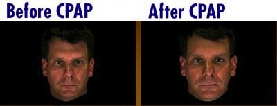 Before and After CPAP images
