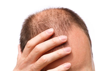 Man going bald
