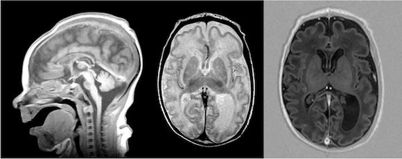 3 MRI scans showing disrupted brain development