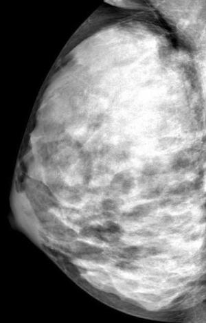 Extremely dense breast tissue