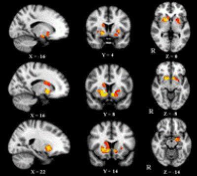Increased Gray Matter Volume Was Observed
